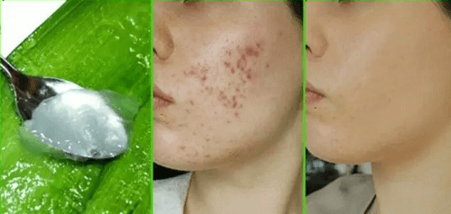Sivilce Nasıl Geçer ? Sivilceye Ne İyi Gelir ? 3 – aloe vera sivilce maskesi